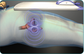 Continuous position and motion information about the prostate are received by the Calypso® 4D Localization System™ identifying sub-millimeter* mis